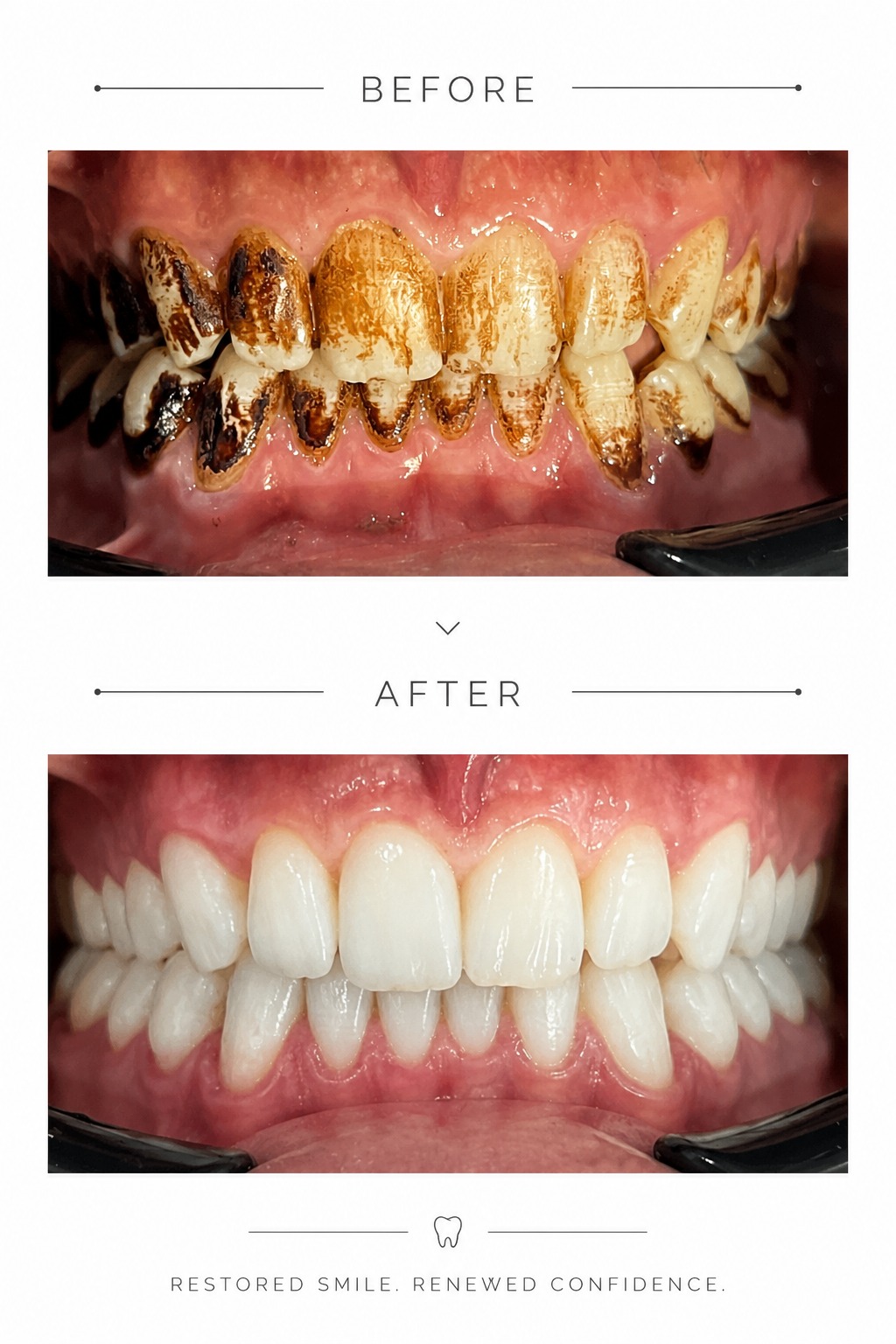 Before and after scaling and polishing